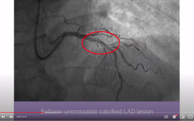 OPN NCTM TWIN Wall Super High Pressure PTCA Balloon and complementary devices for excellent lesion preparation – Florim Cuculi, MD